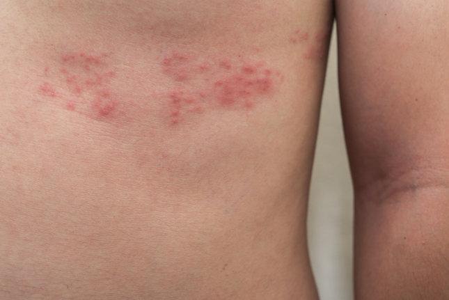 Shingles Vaccination: What You Should Know About It